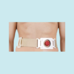 Osto-Mate Permanent Colostomy belt Bag-60MM (Wash & Re-usable)